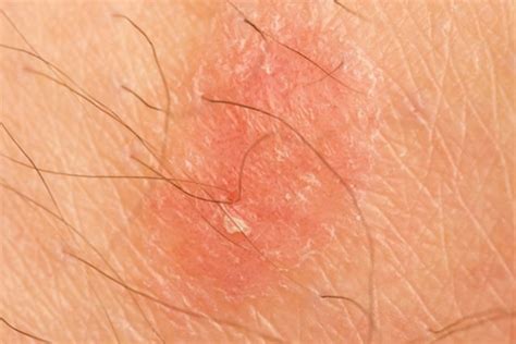 Como Curar Micose na Virilha (Tinea Cruris): 13。